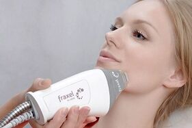 суть процедуры фракционного омоложения кожи лица